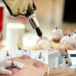 1 Set Cupping Relaxation Kit with Multiple Sizes of Vacuum Cups - Image 5